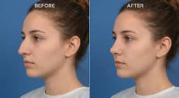 4 Best Rhinoplasty Clinics in Korea for International Patients (2026)